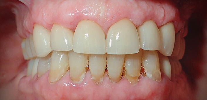Dental crowns after image